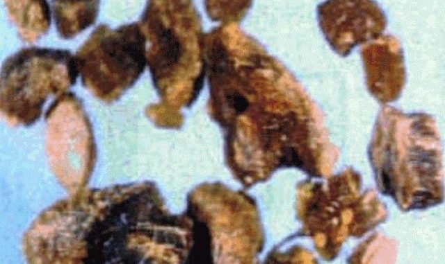 БАЙ ИВАН ОТ СЕЛО ЧАВДАР: С ТОВА ЧУДО ИЗХВЪРЛИХ НАД 100 КАМЪЧЕТА В ЖЛЪЧКАТА, РОДИХ СЕ! ЕТО Я БЕЗЦЕННАТА РЕЦЕПТА!